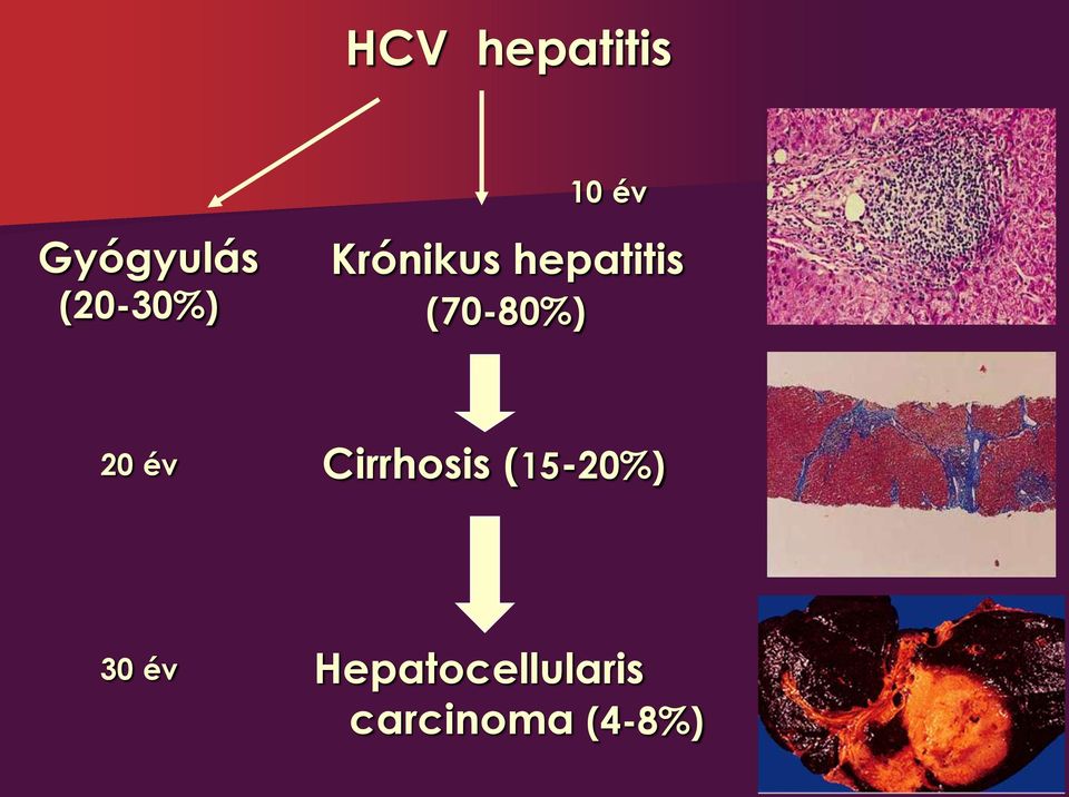 (70-80%) 20 év Cirrhosis