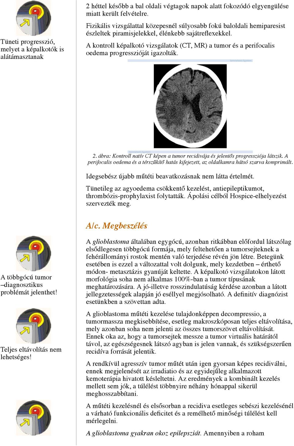 A kontroll képalkotó vizsgálatok (CT, MR) a tumor és a perifocalis oedema progresszióját igazolták. 2. ábra: Kontroll natív CT képen a tumor recidivája és jelentős progressziója látszik.