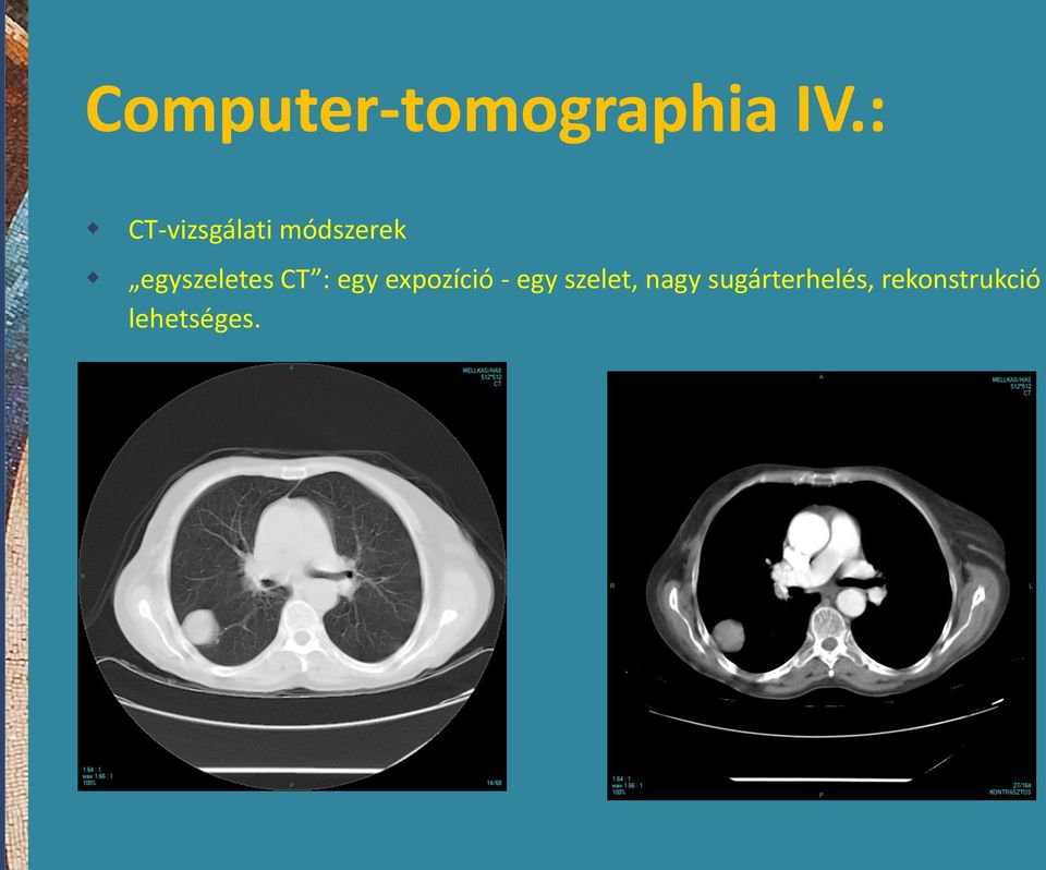 egyszeletes CT : egy expozíció -