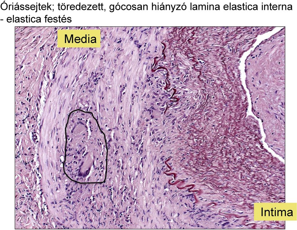 hiányzó lamina elastica