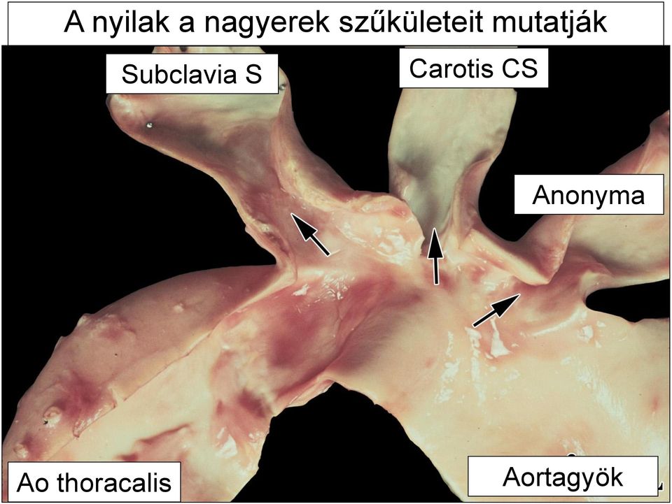 Subclavia S Carotis CS