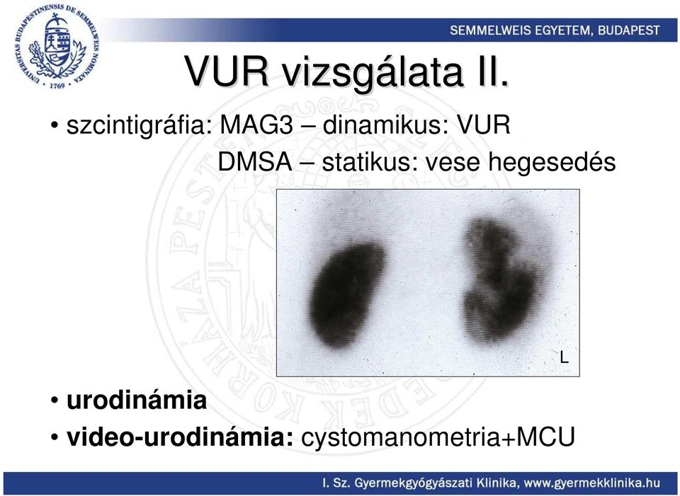 VUR DMSA statikus: vese hegesedés