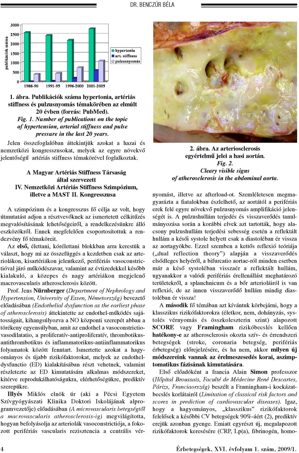 A Magyar Artériás Stiffness Társaság által szervezett IV. Nemzetközi Artériás Stiffness Szimpózium, illetve a MAST II. Kongresszusa 2. ábra. Az arteriosclerosis egyértelmû jelei a hasi aortán. Fig. 2. Cleary visible signs of atherosclerosis in the abdominal aorta.