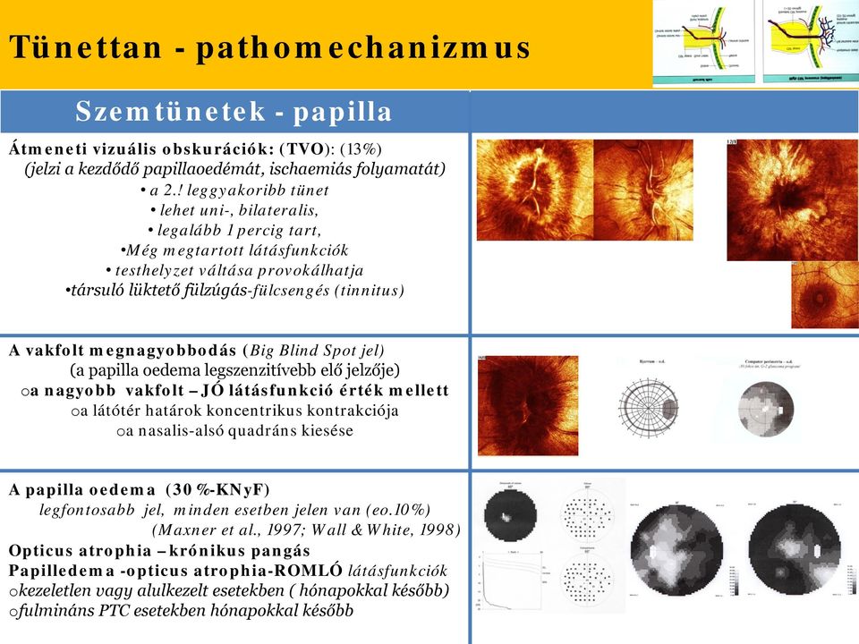 (Big Blind Spt jel) (a papilla edema legszenzitívebb elő jelzője) a nagybb vakflt JÓ látásfunkció érték mellett a látótér határk kncentrikus kntrakciója a nasalis-alsó quadráns kiesése A papilla