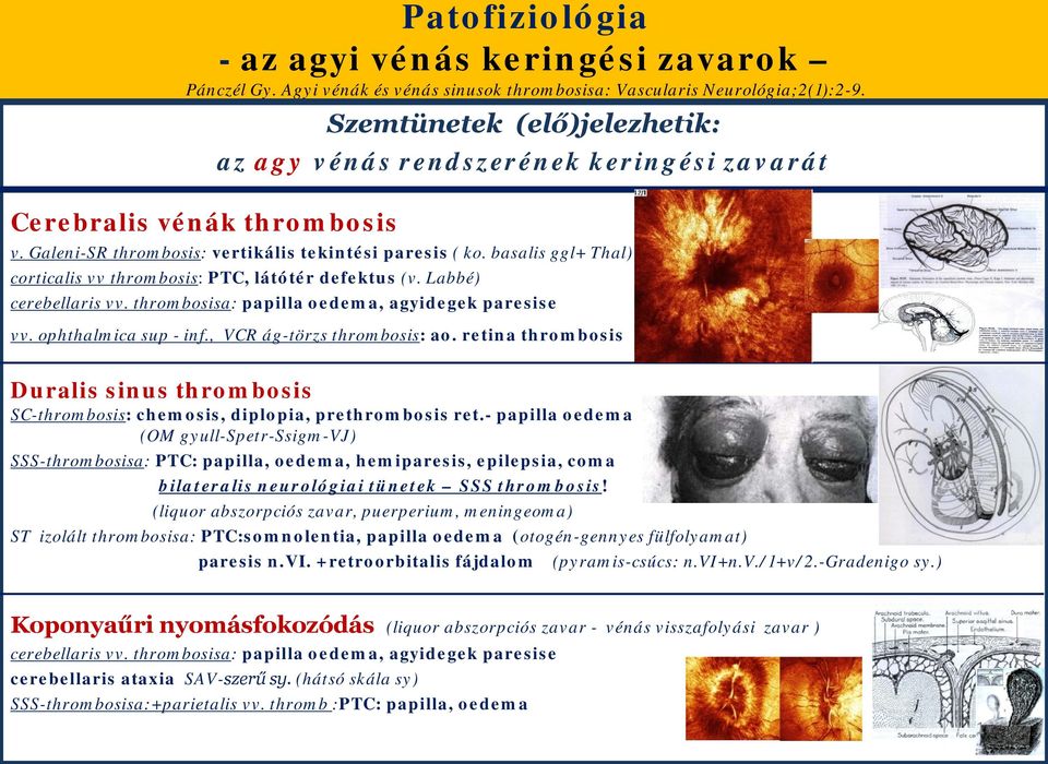 basalis ggl+ Thal) crticalis vv thrmbsis: PTC, látótér defektus (v. Labbé) cerebellaris vv. thrmbsisa: papilla edema, agyidegek paresise vv. phthalmica sup - inf., VCR ág-törzs thrmbsis: a.