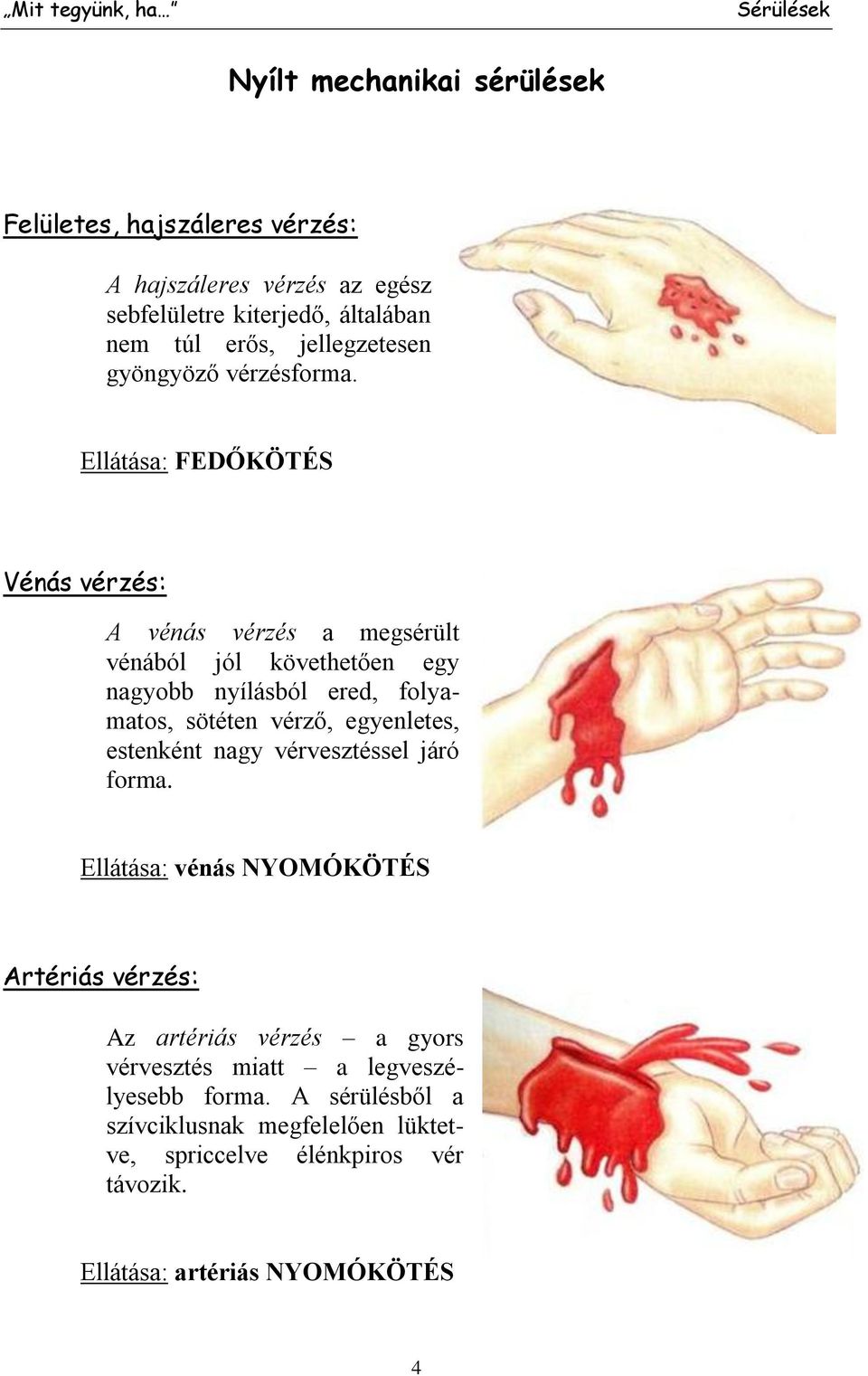 Ellátása: FEDŐKÖTÉS Vénás vérzés: A vénás vérzés a megsérült vénából jól követhetően egy nagyobb nyílásból ered, folyamatos, sötéten vérző,