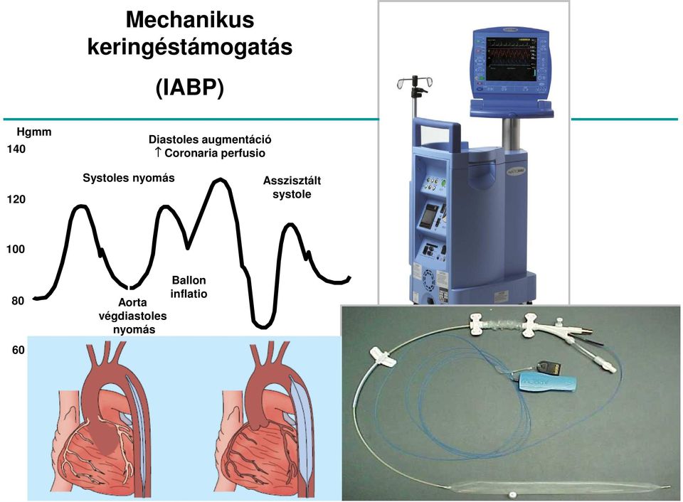 Asszisztált systole 100 80 60 Ballon inflatio Aorta