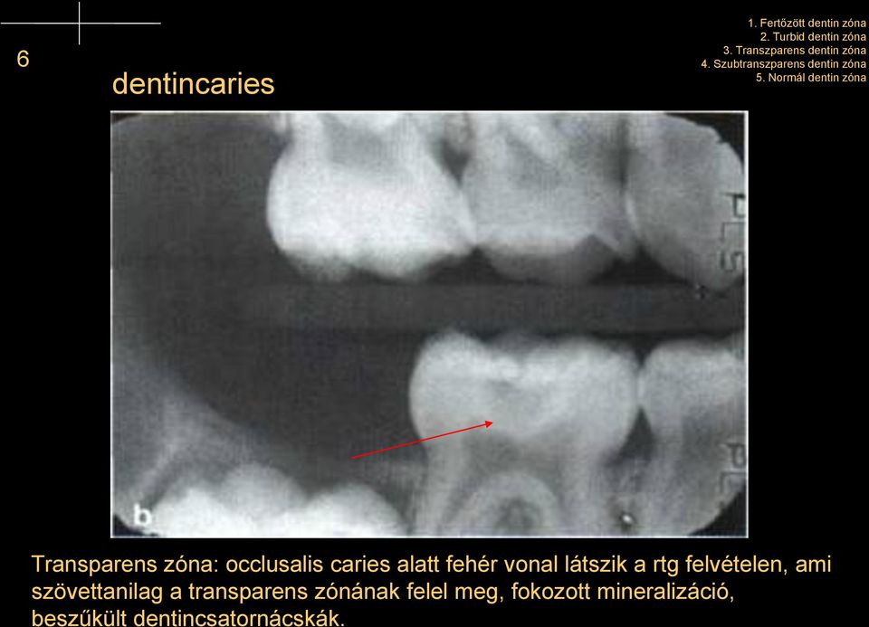 Normál dentin zóna Transparens zóna: occlusalis caries alatt fehér vonal látszik a
