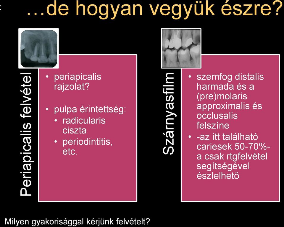 szemfog distalis harmada és a (pre)molaris approximalis és occlusalis felszíne -az