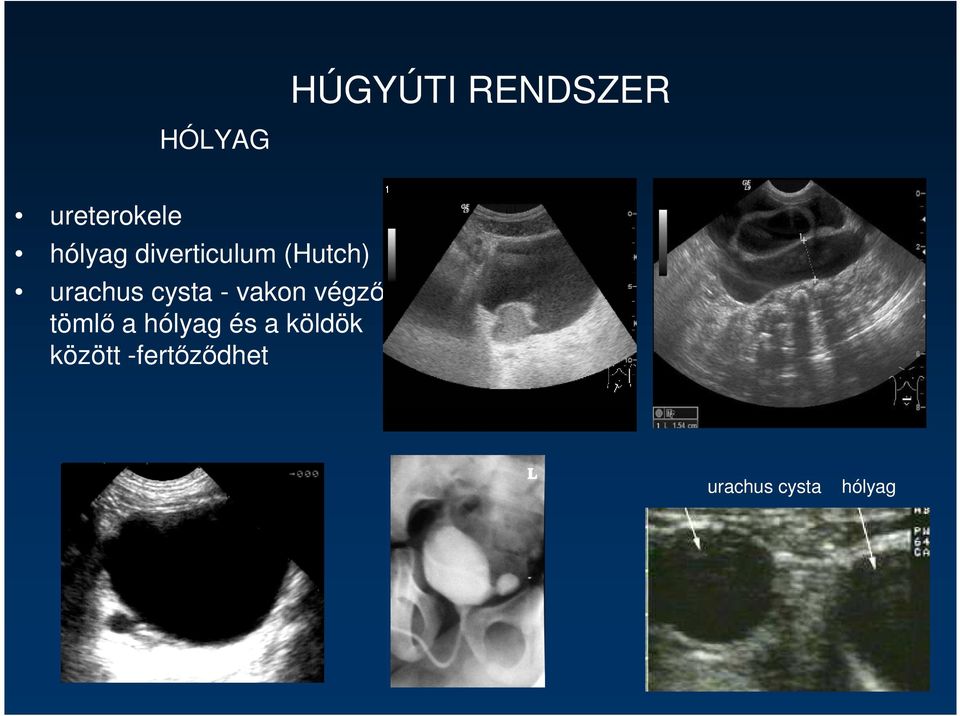 cysta - vakon végzıdı tömlı a hólyag és