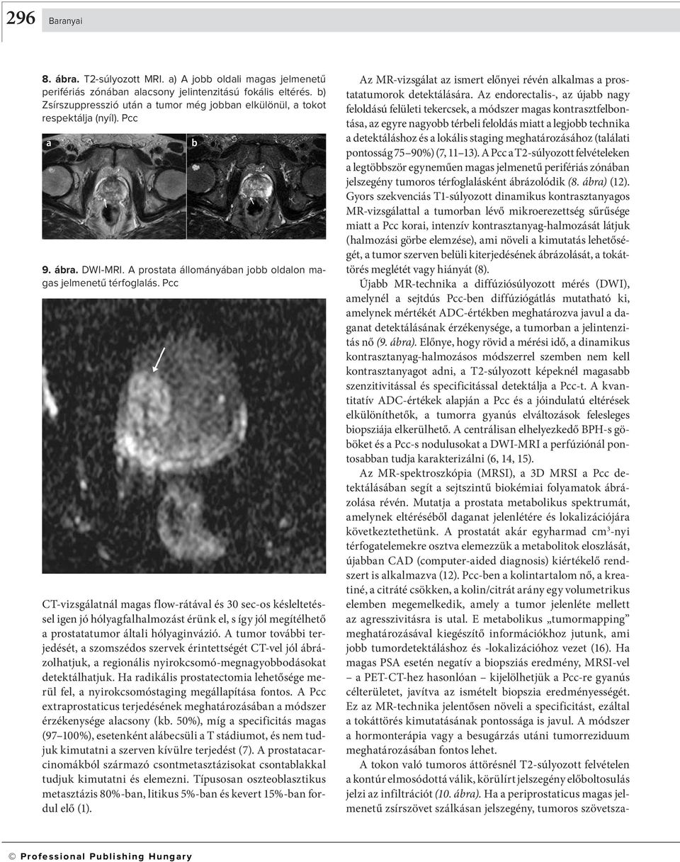 Pcc CT-vizsgáltnál mgs flow-rátávl és 30 sec-os késleltetéssel igen jó hólygflhlmozást érünk el, s így jól megítélhető prostttumor áltli hólyginvázió.