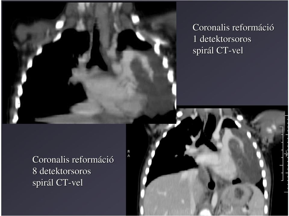 CT-vel Coronalis reformáci