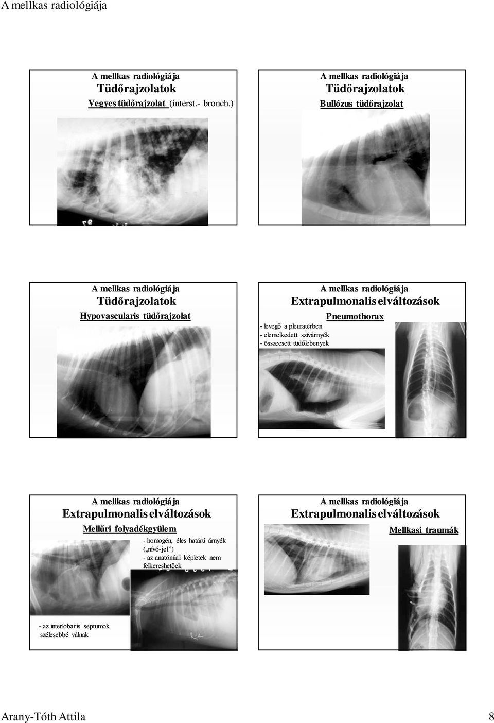 elemelkedett szívárnyék - összeesett tüdılebenyek Pneumothorax Extrapulmonalis elváltozások Mellőri