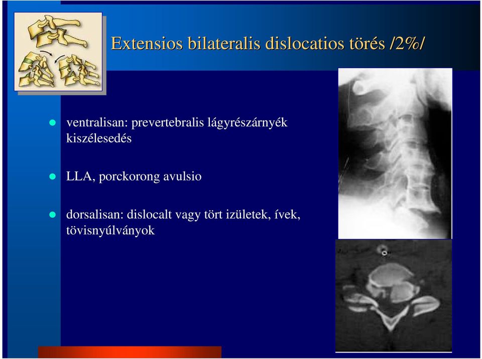 kiszélesedés LLA, porckorong avulsio