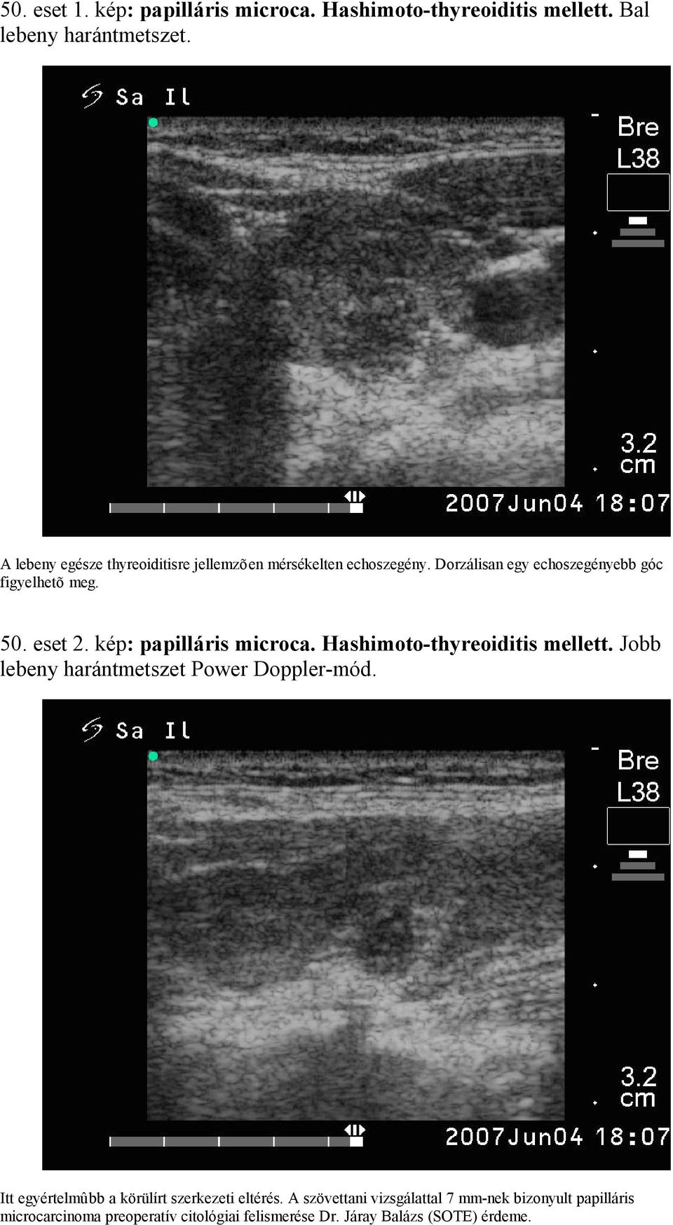 kép: papilláris microca. Hashimoto-thyreoiditis mellett. Jobb lebeny harántmetszet Power Doppler-mód.