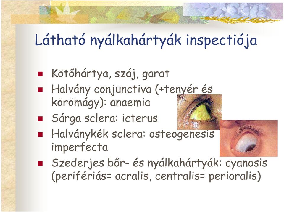 icterus Halványkék sclera: osteogenesis imperfecta Szederjes