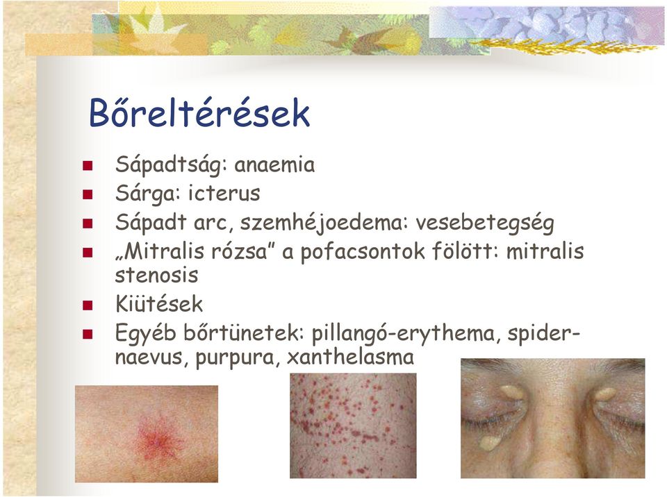 pofacsontok fölött: mitralis stenosis Kiütések Egyéb