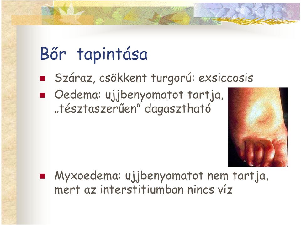 tésztaszerően dagasztható Myxoedema: