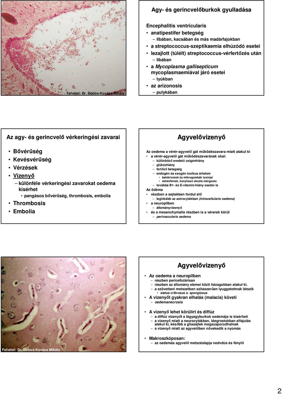 Vérzések Vizenyı különféle vérkeringési zavarokat oedema kísérhet pangásos bıvérőség, thrombosis, embolia Thrombosis Embolia Agyvelıvizeny vizenyı Az oedema a vérér-agyvelı gát mőködészavara miatt