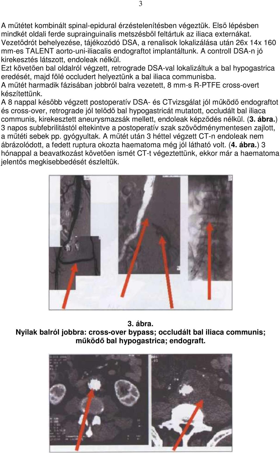 Ezt követıen bal oldalról végzett, retrograde DSA-val lokalizáltuk a bal hypogastrica eredését, majd fölé occludert helyeztünk a bal iliaca communisba.
