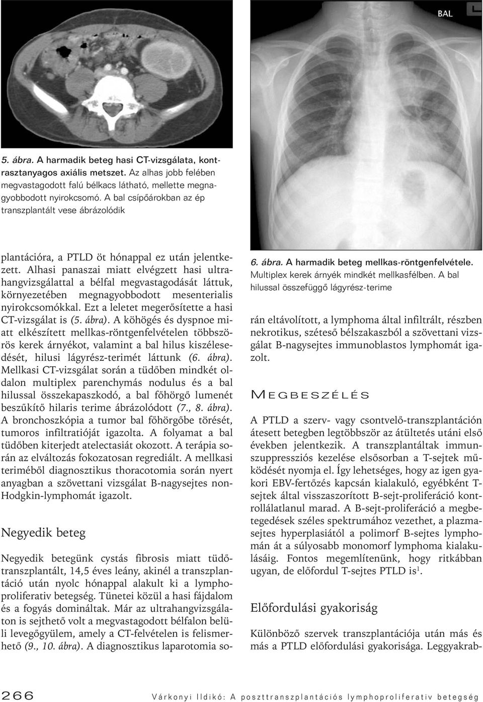 Alhasi panaszai miatt elvégzett hasi ultrahangvizsgálattal a bélfal megvastagodását láttuk, környezetében megnagyobbodott mesenterialis nyirokcsomókkal.