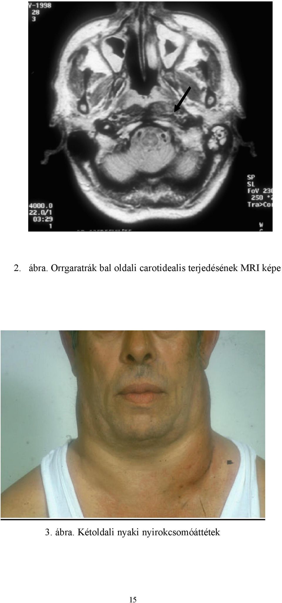 carotidealis terjedésének