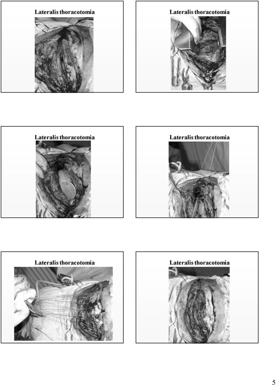 thoracotomia 5