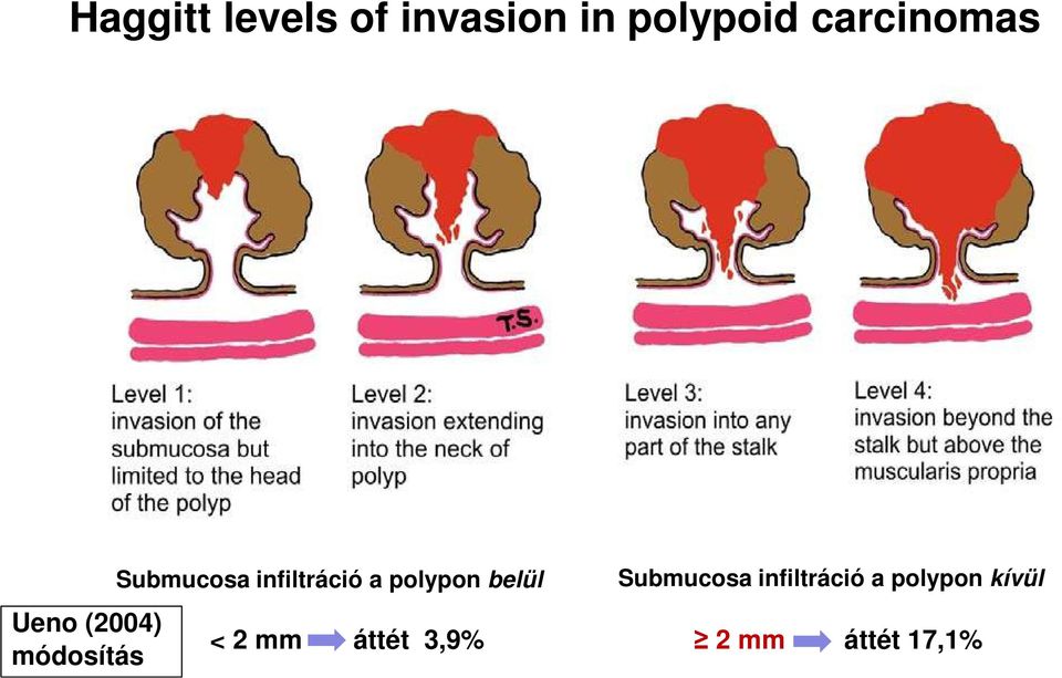 infiltráció a polypon belül Submucosa