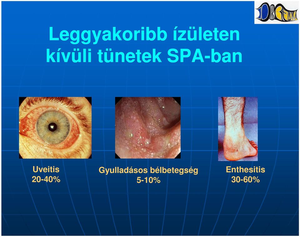 Uveitis 20-40% Gyulladásos