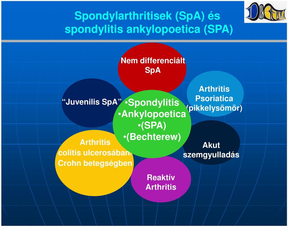 Nem differenciált SpA Spondylitis Ankylopoetica (SPA) (Bechterew)