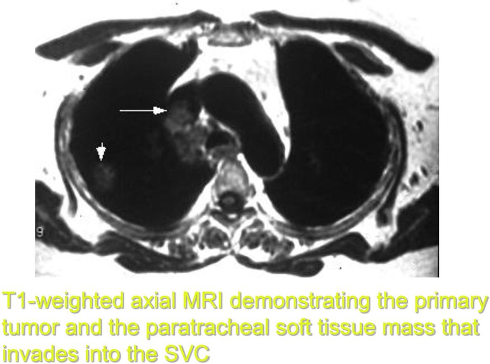 tumor and the paratracheal