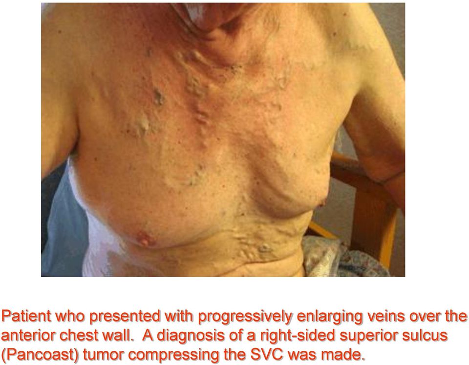 A diagnosis of a right-sided superior sulcus
