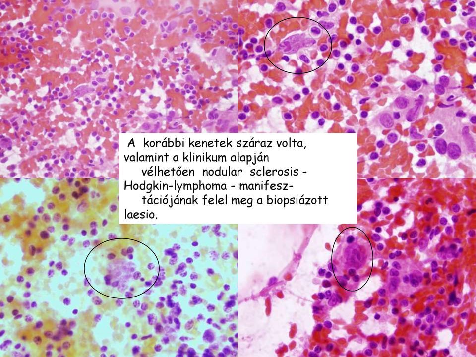 nodular sclerosis - Hodgkin-lymphoma -