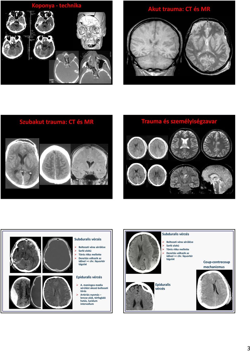 liquortér tágulat Subduralis vérzés Boltozati véna  liquortér tágulat Coup contrecoup mechanizmus Epiduralis vérzés A.