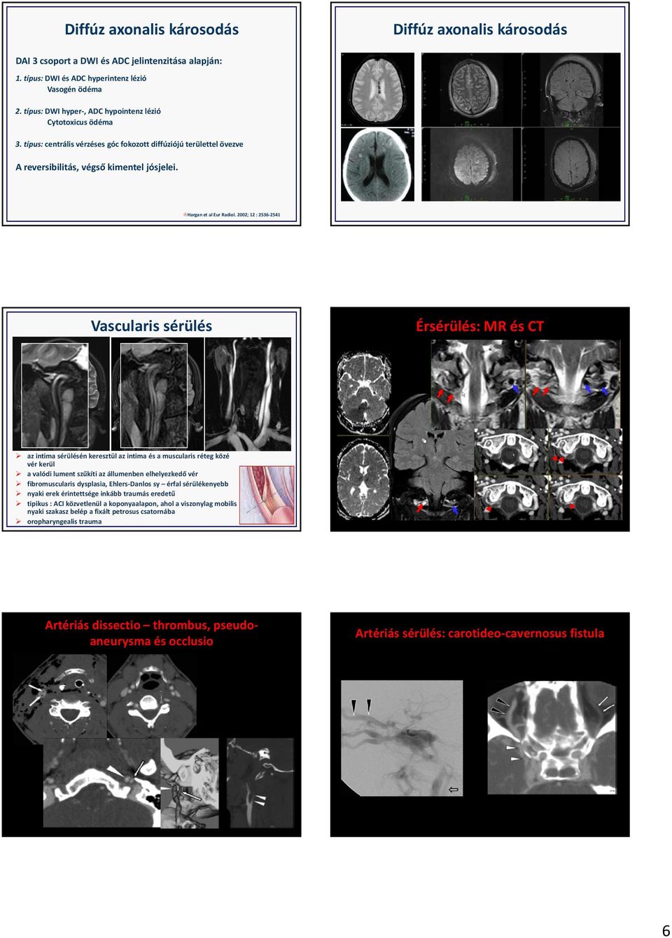 2002; 12 : 2536 2541 Vascularis sérülés Érsérülés: MR és CT az intima sérülésén keresztül az intima és a muscularis réteg közé vér kerül a valódi lument szűkíti az állumenben elhelyezkedő vér