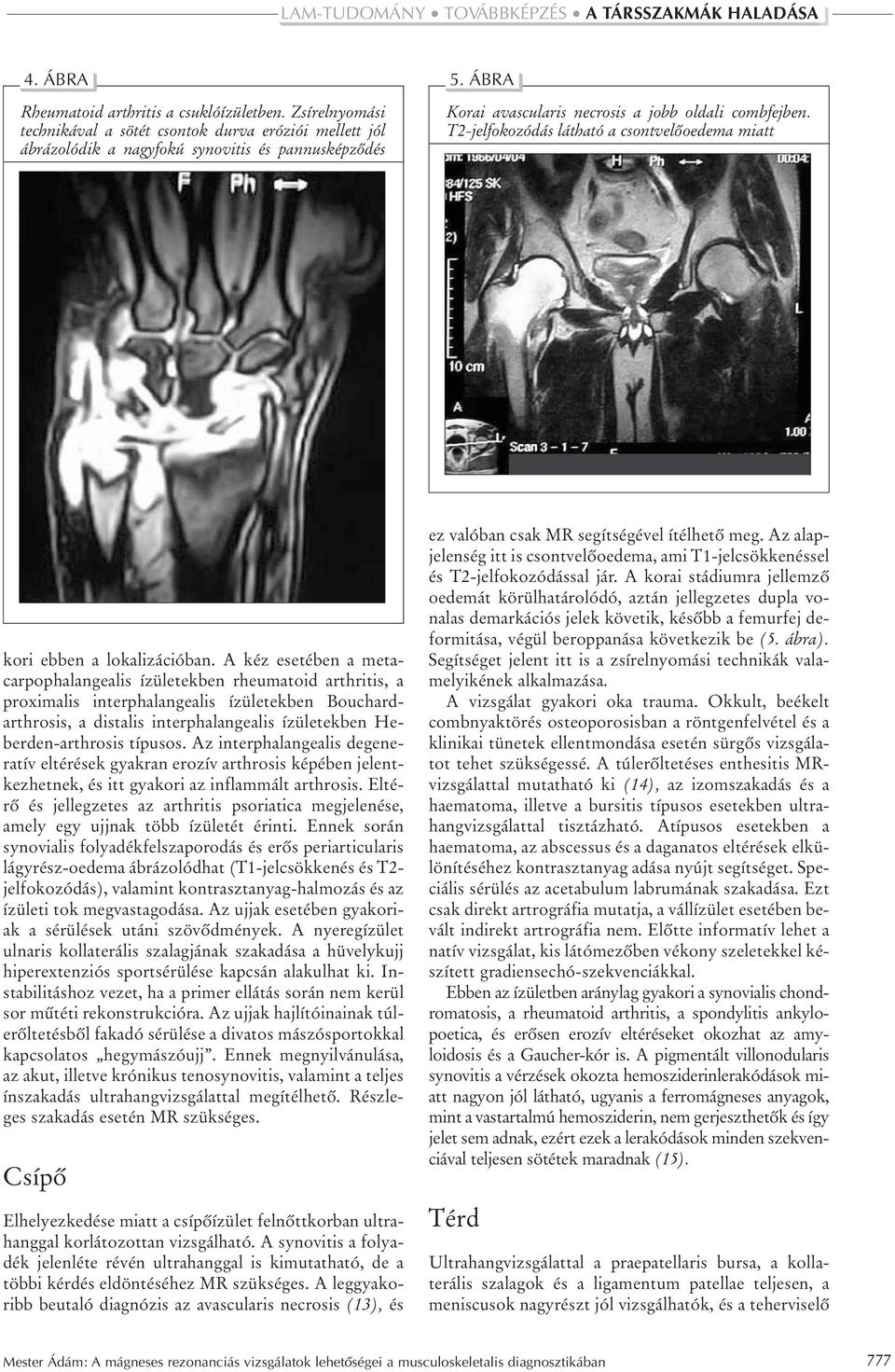 A kéz esetében a metacarpophalangealis ízületekben rheumatoid arthritis, a proximalis interphalangealis ízületekben Bouchardarthrosis, a distalis interphalangealis ízületekben Heberden-arthrosis