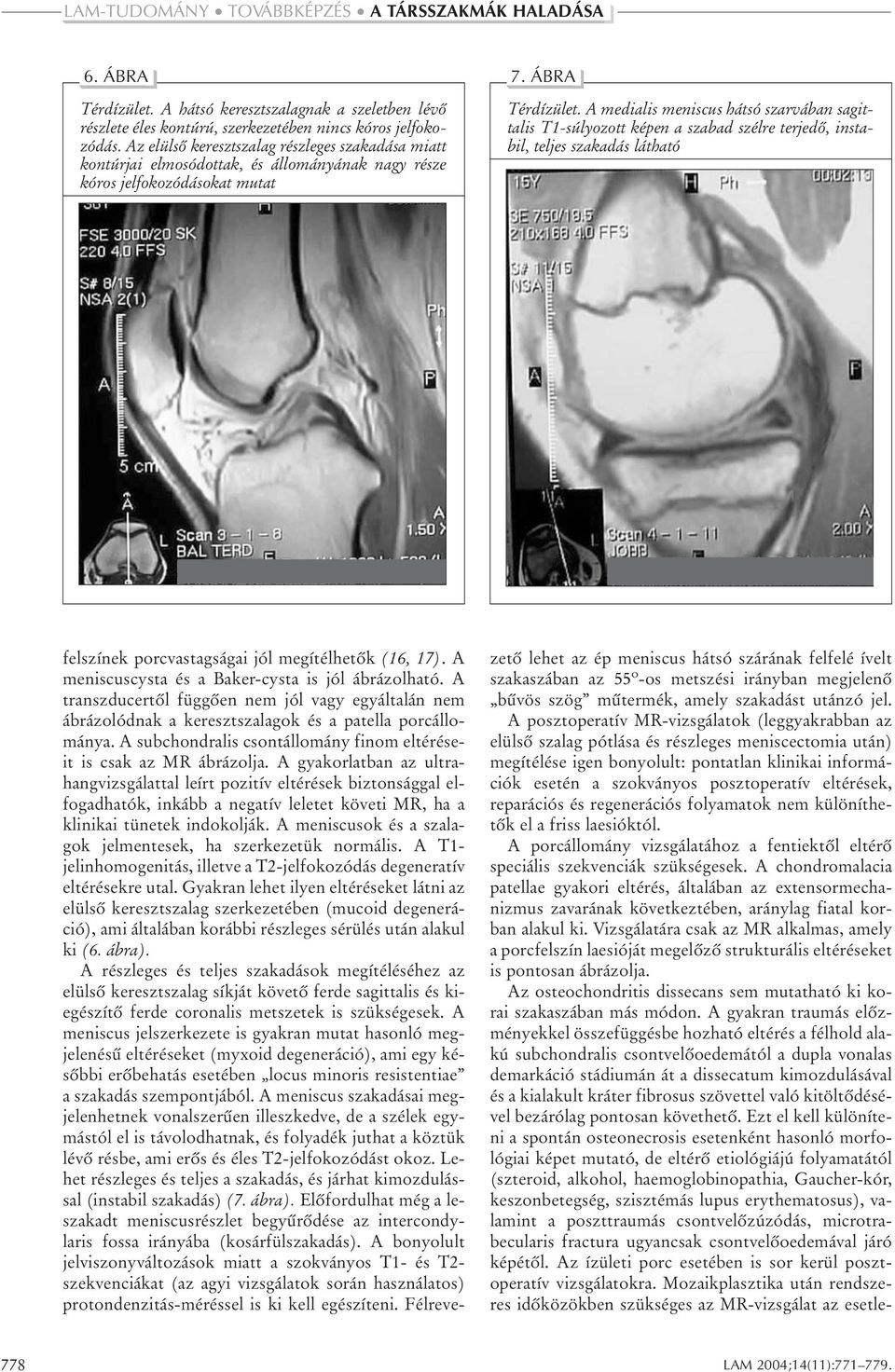 A medialis meniscus hátsó szarvában sagittalis T1-súlyozott képen a szabad szélre terjedõ, instabil, teljes szakadás látható felszínek porcvastagságai jól megítélhetõk (16, 17).