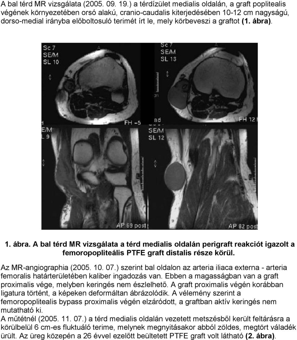 körbeveszi a graftot (1. ábra). 1. ábra. A bal térd MR vizsgálata a térd medialis oldalán perigraft reakciót igazolt a femoropopliteális PTFE graft distalis része körül. Az MR-angiographia (2005. 10.