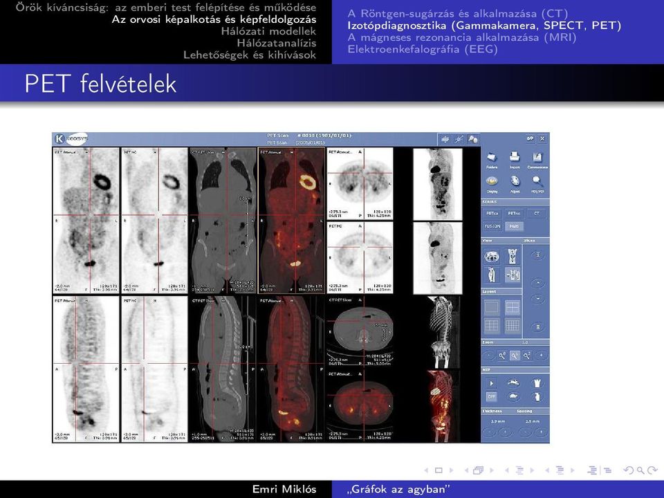 (Gammakamera, SPECT, PET) A mágneses