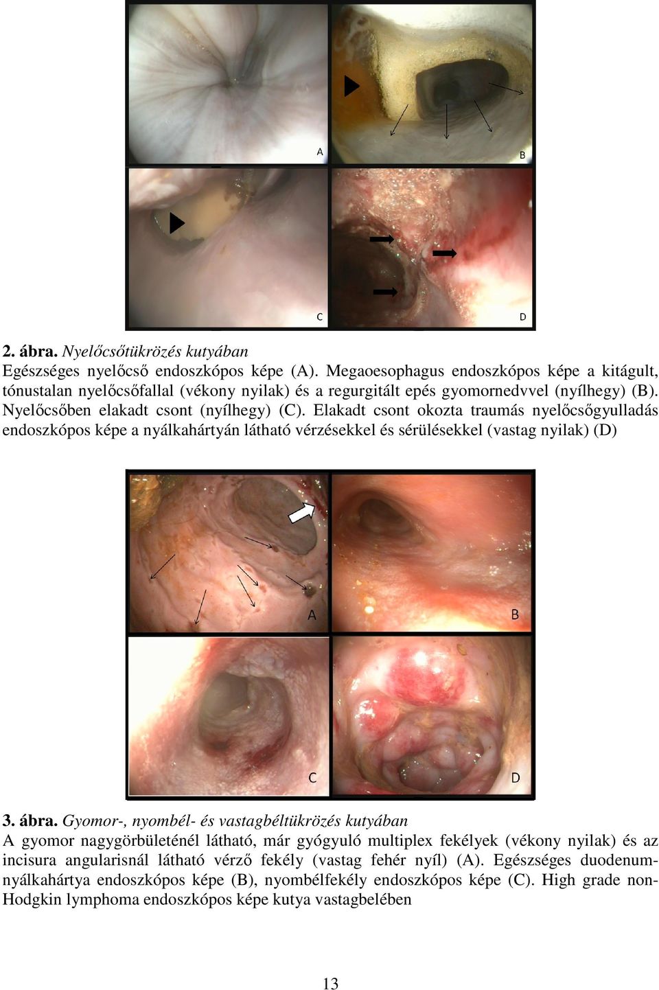 Elakadt csont okozta traumás nyelőcsőgyulladás endoszkópos képe a nyálkahártyán látható vérzésekkel és sérülésekkel (vastag nyilak) (D) 3. ábra.