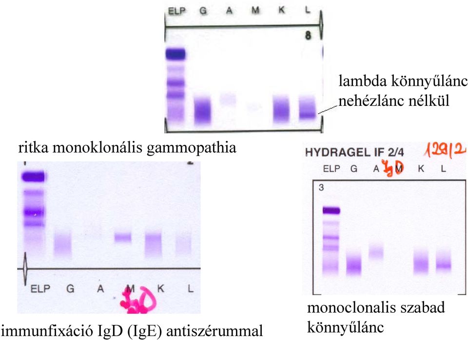 gammopathia immunfixáció IgD