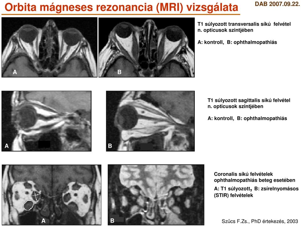 opticusok szintjében A: kontroll, B: ophthalmopathiás A B Coronalis síkú felvételek