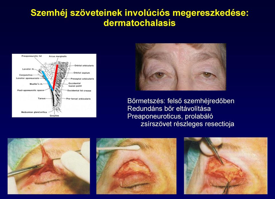 felső szemhéjredőben Redundáns bőr