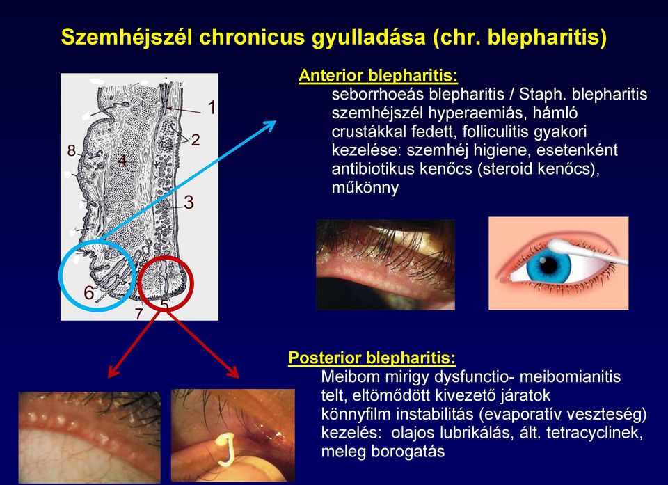 esetenként antibiotikus kenőcs (steroid kenőcs), műkönny Posterior blepharitis: Meibom mirigy dysfunctio- meibomianitis