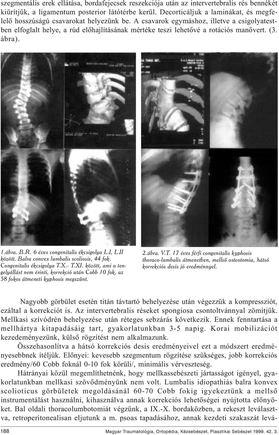 A csavarok egymáshoz, illetve a csigolyatestben elfoglalt helye, a rúd elõhajlításának mértéke teszi lehetõvé a rotációs manõvert. (3. ábra). 1.ábra. B.R. 6 éves congenitalis ékcsigolya L.I, L.