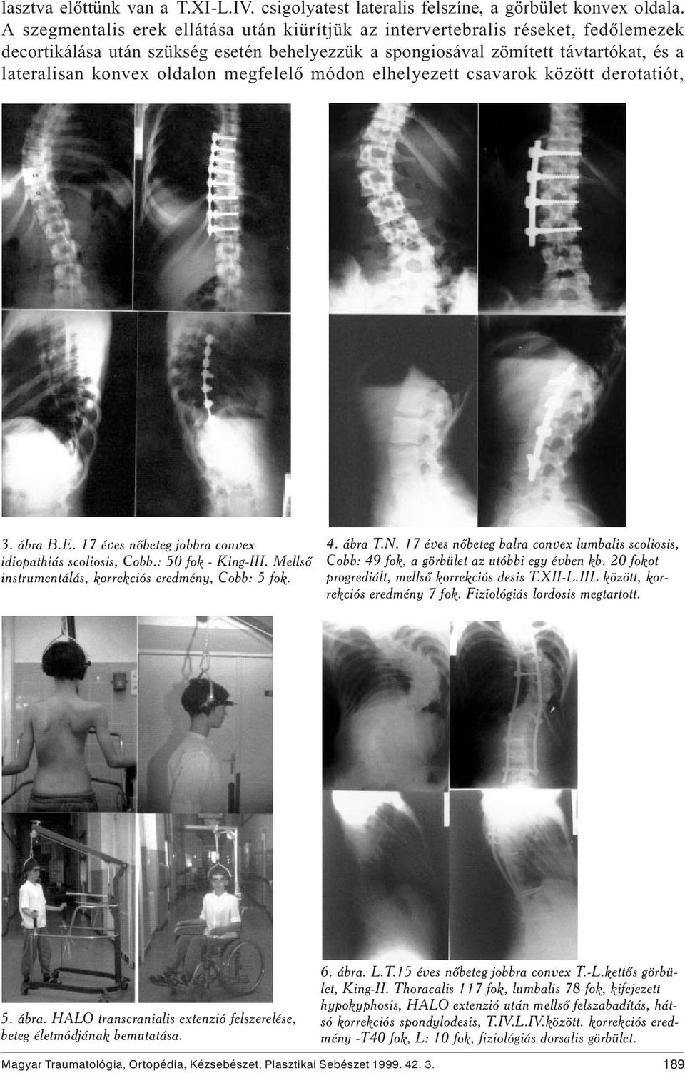 megfelelõ módon elhelyezett csavarok között derotatiót, 3. ábra B.E. 17 éves nõbeteg jobbra convex idiopathiás scoliosis, Cobb.: 50 fok - King-III.