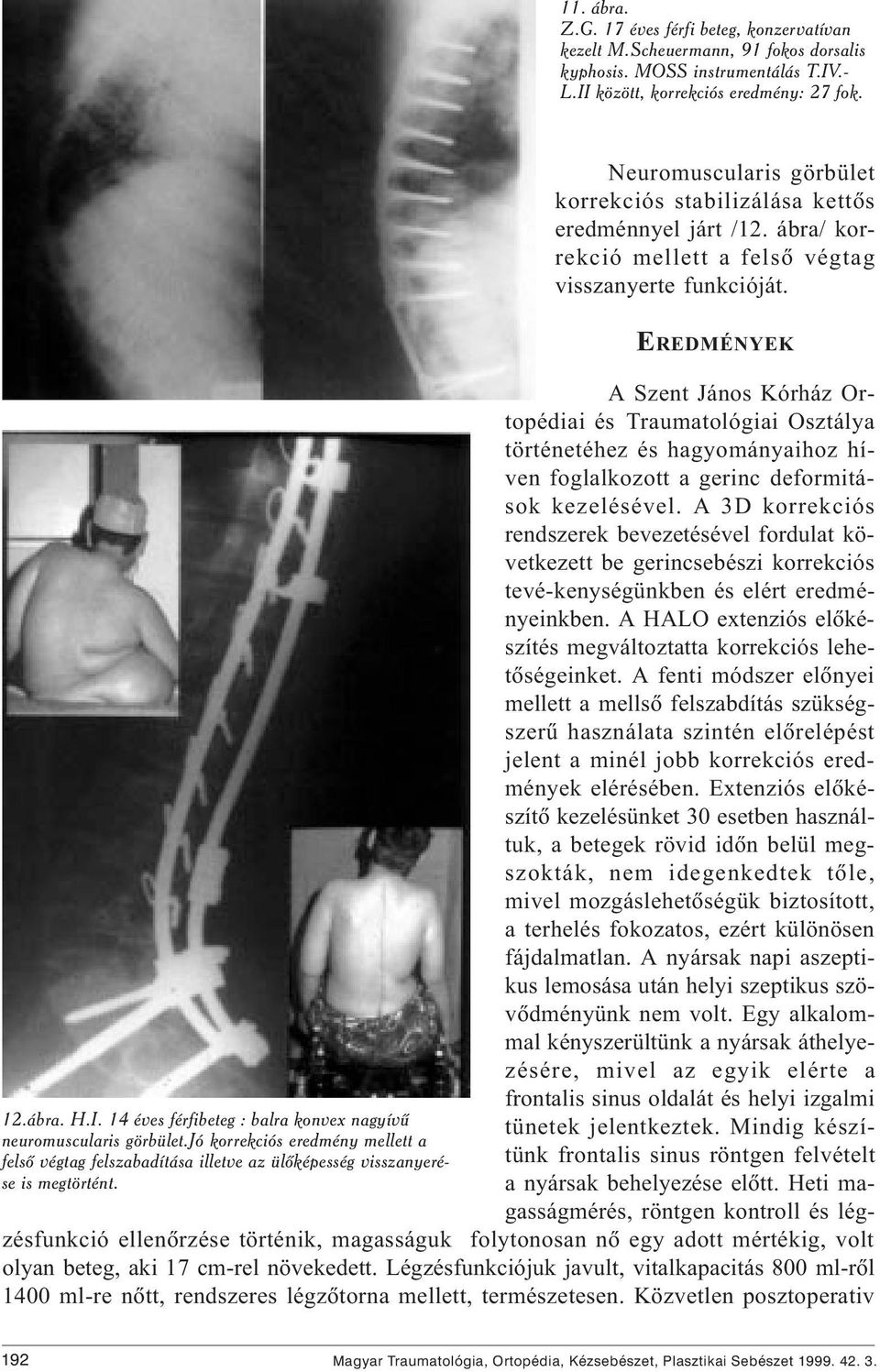 14 éves férfibeteg : balra konvex nagyívû neuromuscularis görbület.jó korrekciós eredmény mellett a felsõ végtag felszabadítása illetve az ülõképesség visszanyerése is megtörtént.