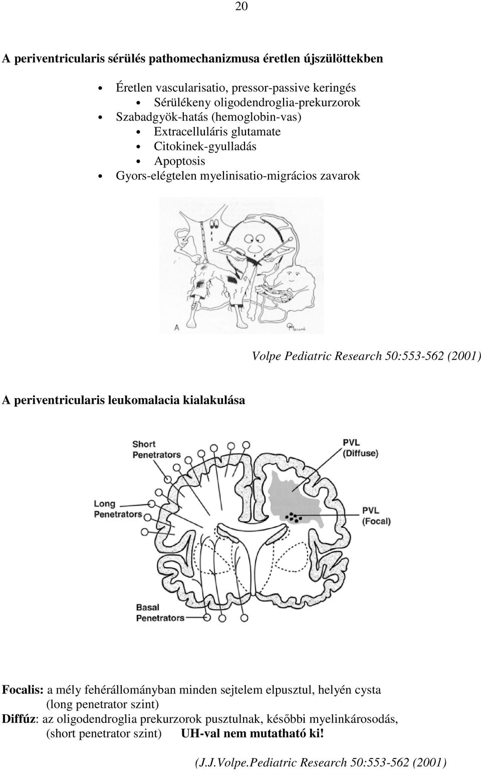 50:553-562 (2001) A periventricularis leukomalacia kialakulása Focalis: a mély fehérállományban minden sejtelem elpusztul, helyén cysta (long penetrator szint)