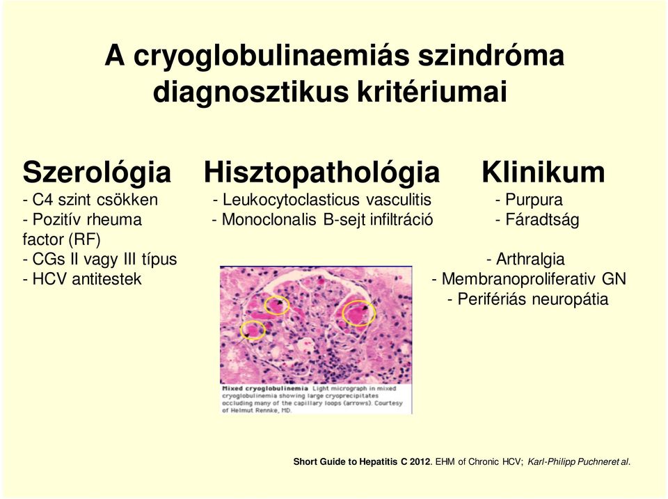 infiltráció - Fáradtság factor (RF) - CGs II vagy III típus - Arthralgia - HCV antitestek -