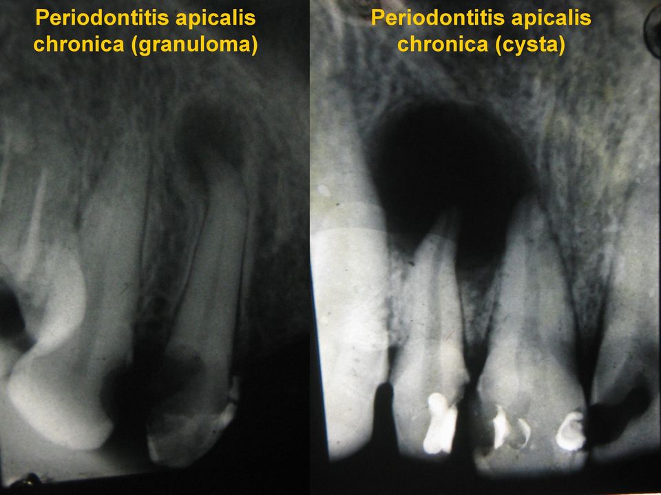 (granuloma)  